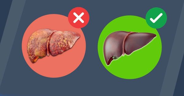 Disintossicare il fegato – elimina il grasso sulla pancia