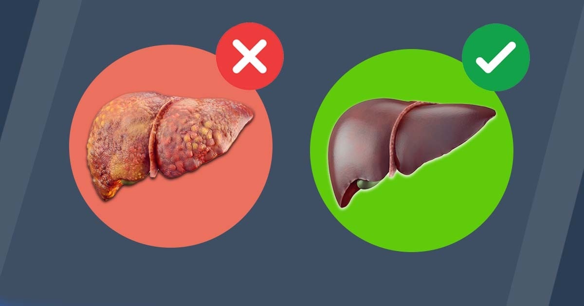 Disintossicare il fegato – elimina il grasso sulla pancia