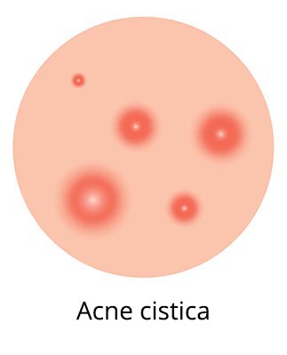 acne cistica