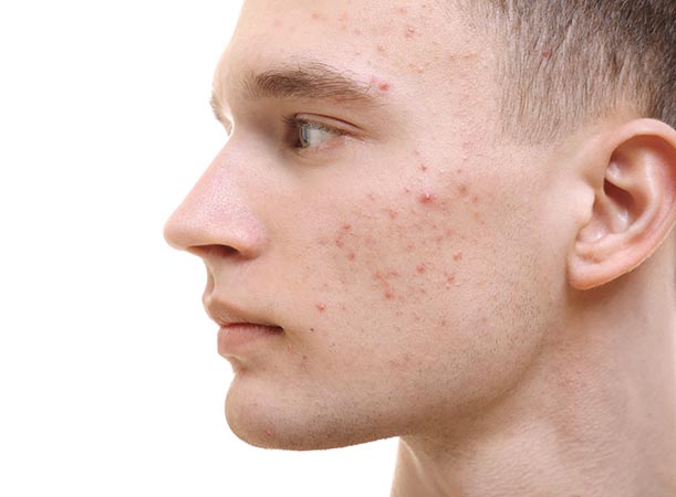 cos’è l’acne