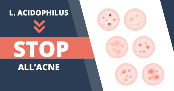 Cos’è l’acne e come curarla?